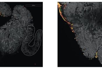 Fusobacterium: πιθανός βιοδείκτης στον καρκίνο παχέος εντέρου