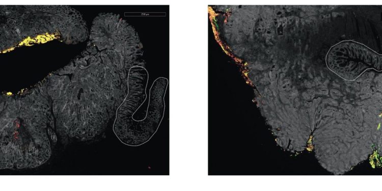 Fusobacterium: πιθανός βιοδείκτης στον καρκίνο παχέος εντέρου